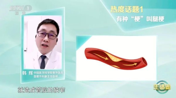 新玺配资 血管堵没堵 走两步! 改掉这6个坏习惯让你的血管强大起来